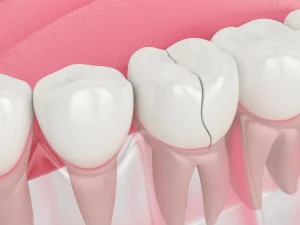 răng sứ bị vỡ phải làm sao