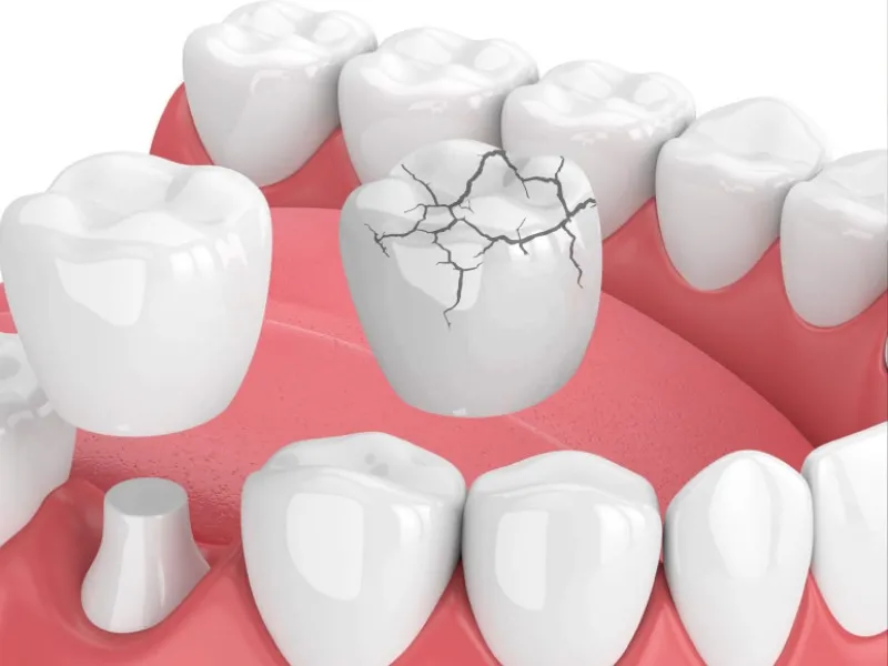 Nguyên nhân khiến răng sứ bị vỡ