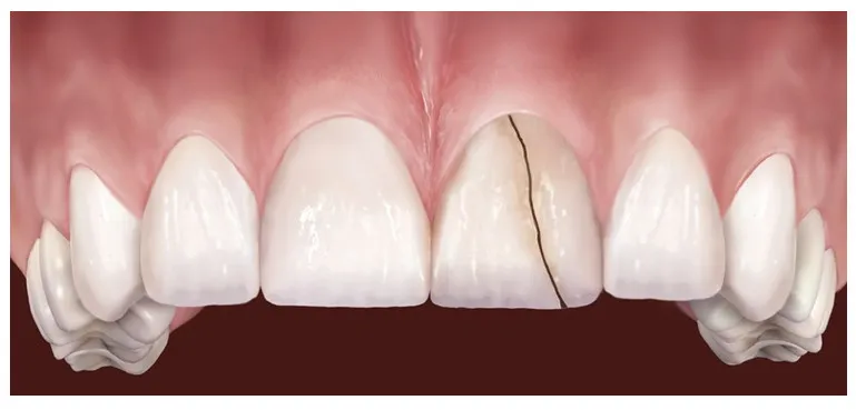 Do lực tác động mạnh từ bên ngoài