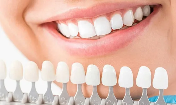 Răng sứ Cercon là gì?