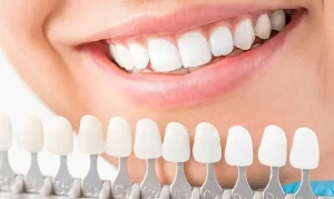 răng sứ cercon có tốt không