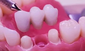 răng sứ cho người bị mất răng