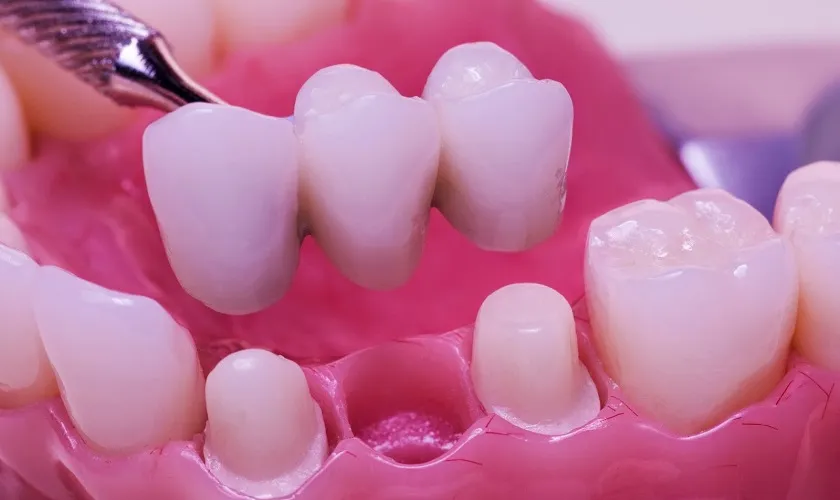 răng sứ cho người bị mất răng