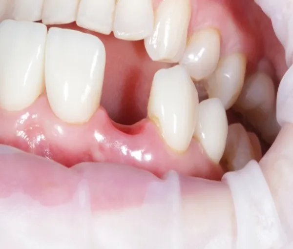 Các giải pháp răng sứ cho người bị mất răng phổ biến nhất