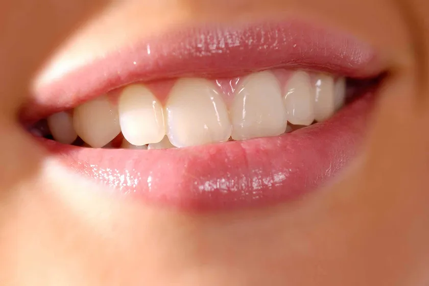 Hàm giả tháo lắp có răng sứ