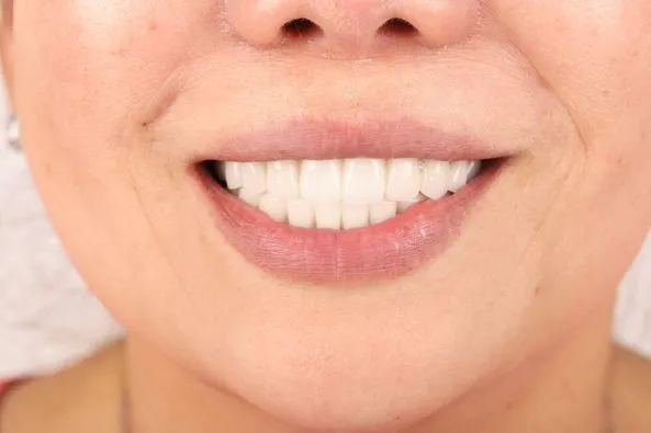 Cải thiện chức năng ăn nhai