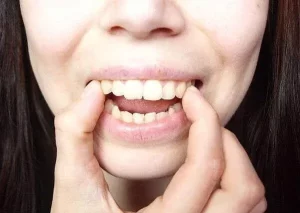 răng sứ cho răng hô