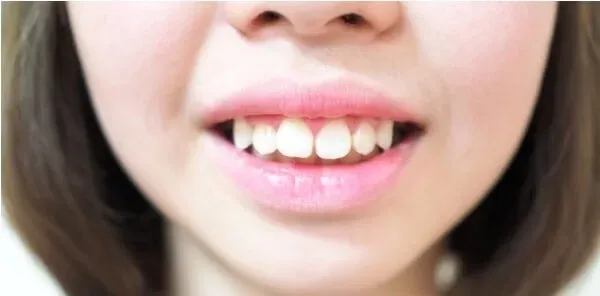 Răng sứ có phù hợp cho răng hô không?