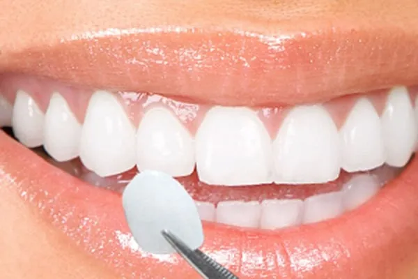 Lợi ích khi bọc răng sứ cho răng hô ở trường hợp phù hợp