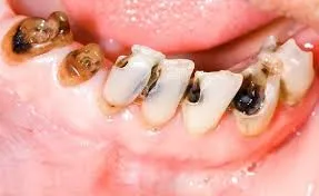 răng sứ cho răng sâu