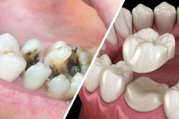 Lợi ích của việc bọc răng sứ cho răng sâu