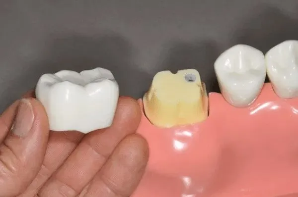 Bảo vệ răng thật khỏi tổn thương thêm