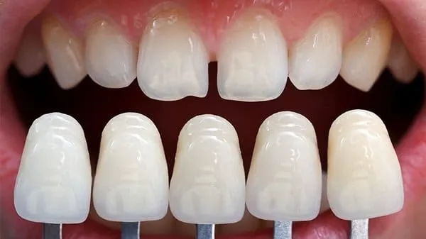 Răng thưa là gì? Khi nào cần can thiệp?