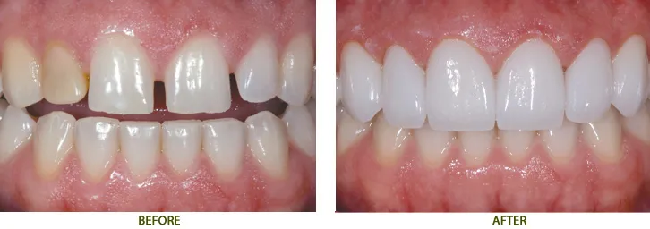 Lợi ích khi bọc răng sứ cho răng thưa