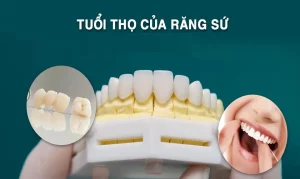 răng sứ có bền không