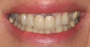 răng sứ có bị đổi màu không
