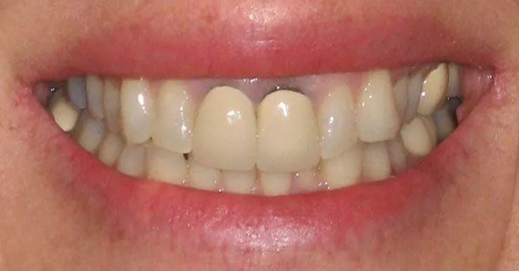 răng sứ có bị đổi màu không