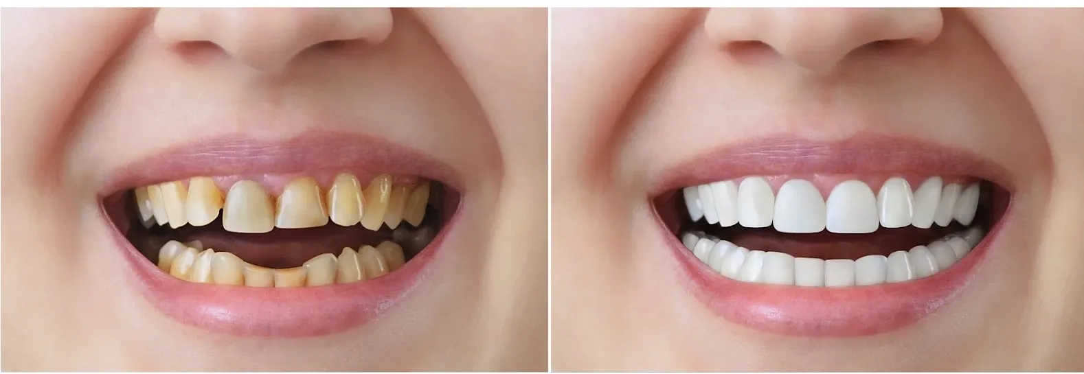 Răng sứ toàn sứ: Gần như không bị đổi màu
