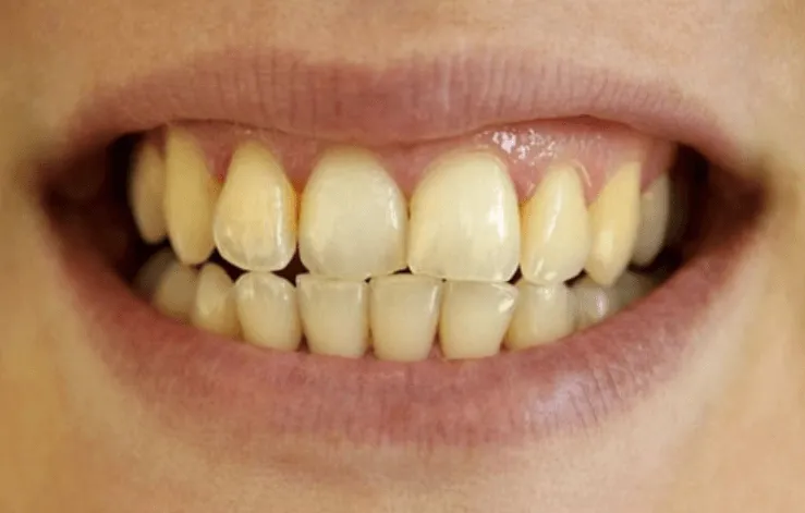 răng sứ có bị ố vàng không