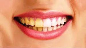 Răng sứ có bị đổi màu không?