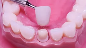 răng sứ có phải là răng giả không