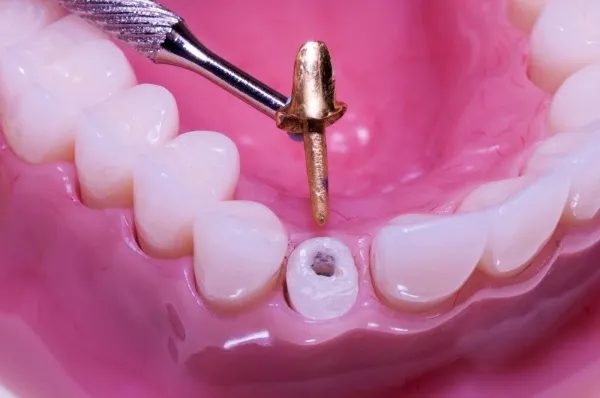 Các loại "răng giả" bằng sứ và ứng dụng của chúng