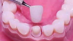 răng sứ có tháo ra được không