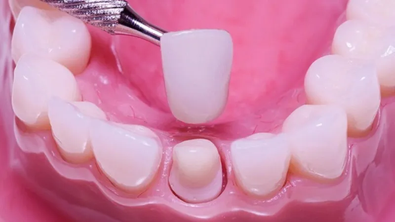 răng sứ có tháo ra được không