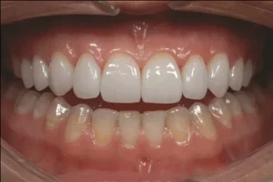 răng sứ có trắng tự nhiên không