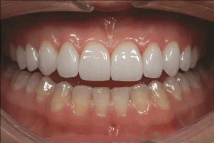 răng sứ có trắng tự nhiên không