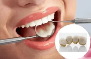 răng sứ dùng được bao lâu