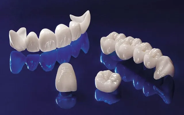 Phân loại răng sứ phổ biến hiện nay