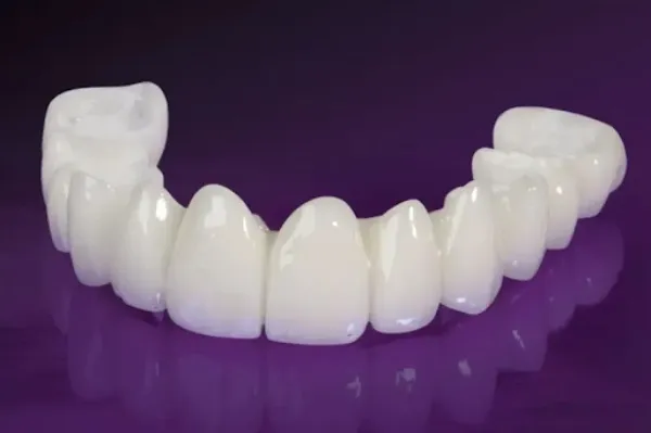Lựa chọn loại răng sứ phù hợp với nhu cầu và ngân sách