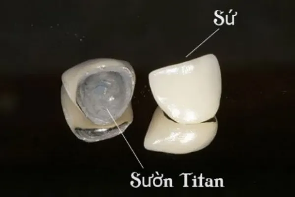 Răng sứ Titan là gì?