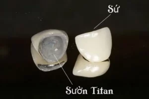 răng sứ titan là gì