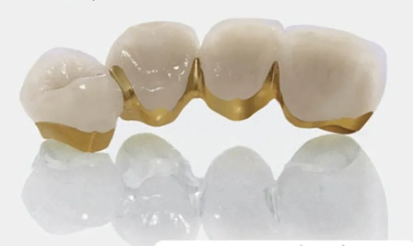 Cấu tạo của răng sứ Titan
