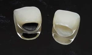 răng sứ toàn sứ và răng sứ kim loại