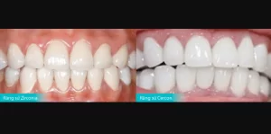 so sánh răng sứ zirconia và cercon
