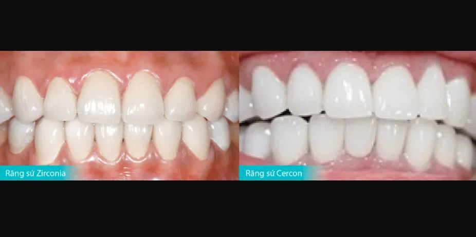 so sánh răng sứ zirconia và cercon
