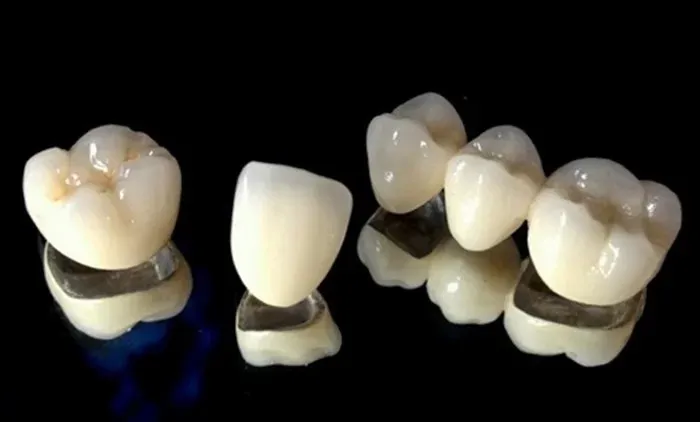 So sánh chi tiết các đặc điểm của răng sứ Zirconia (và Cercon)