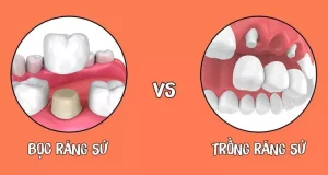 trồng răng sứ khác gì bọc răng sứ