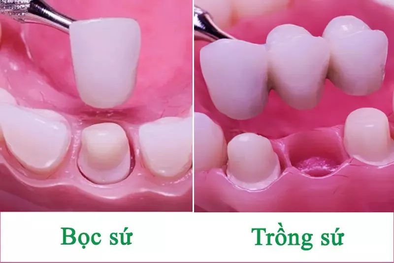 Trồng răng sứ (hay Cấy ghép Implant nha khoa)