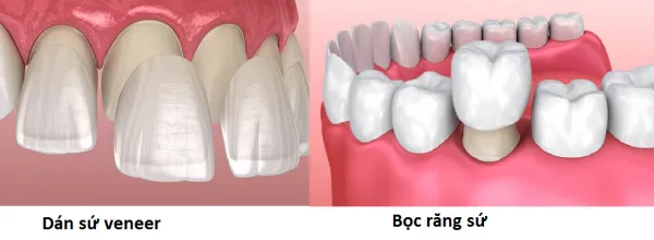Bọc răng sứ (hay Mão răng sứ/Chụp răng sứ)