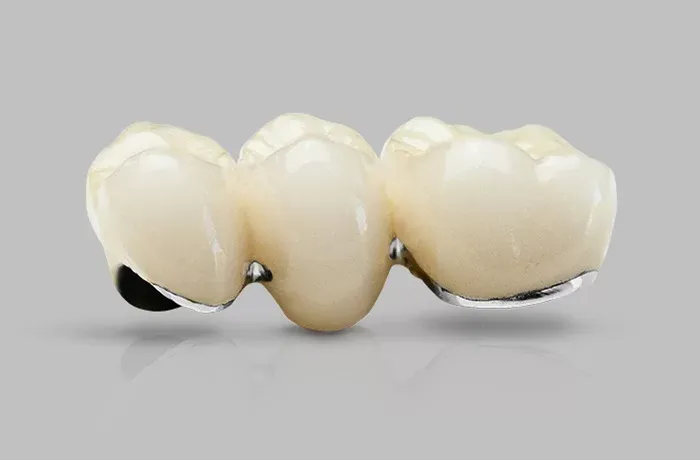 Răng sứ kim loại (Sứ kim loại thường, Sứ Titan)