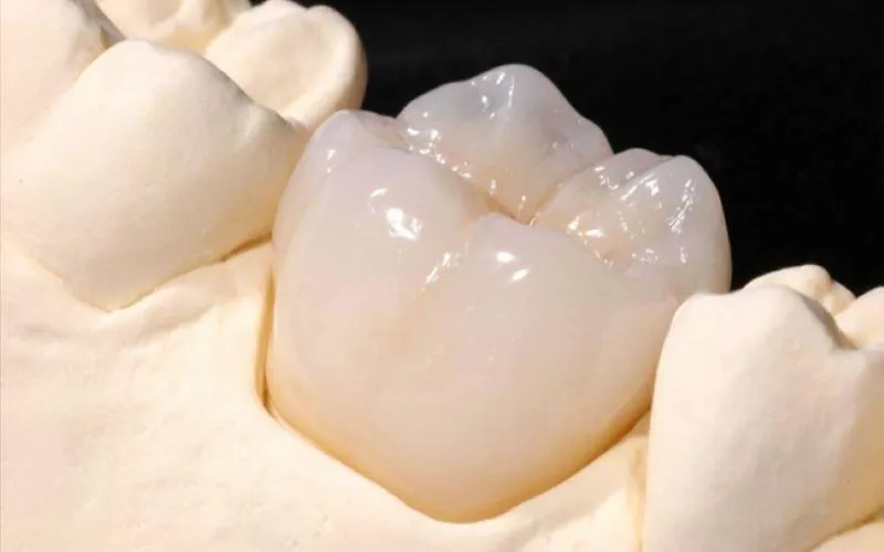 Răng toàn sứ (Zirconia, Cercon, Emax, Lava Plus,...)